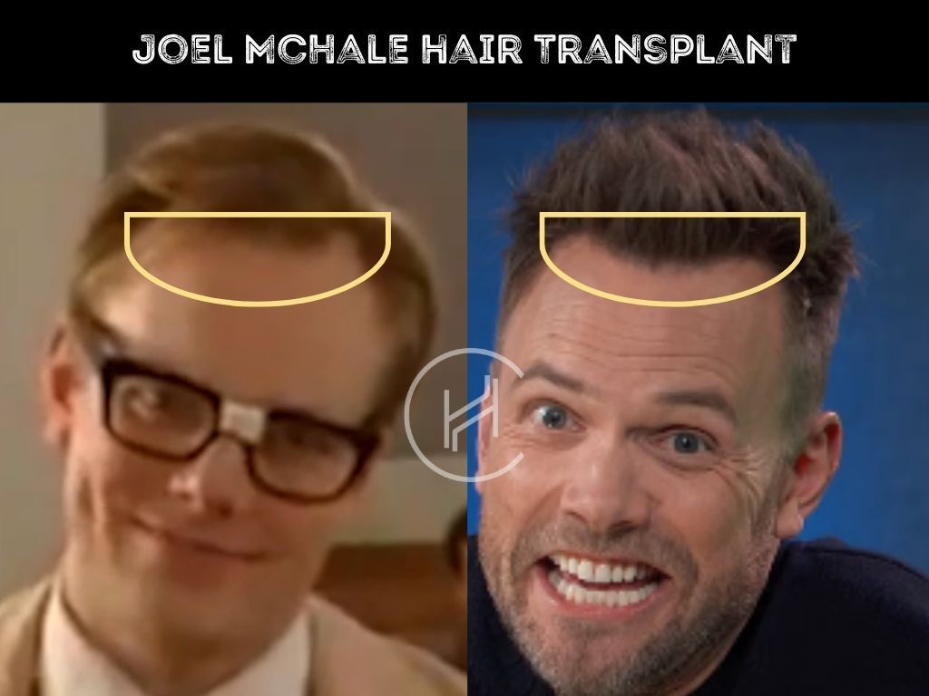 Joel Mchale Hair Transplant - Hair Loss &amp; Technical Analysis regarding How Mchale &amp;amp; Mchale Approach Sustainable Landscaping Solutions
